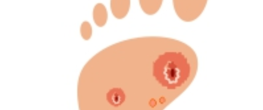 Diabetes and Feet – Diabetic Foot Infection